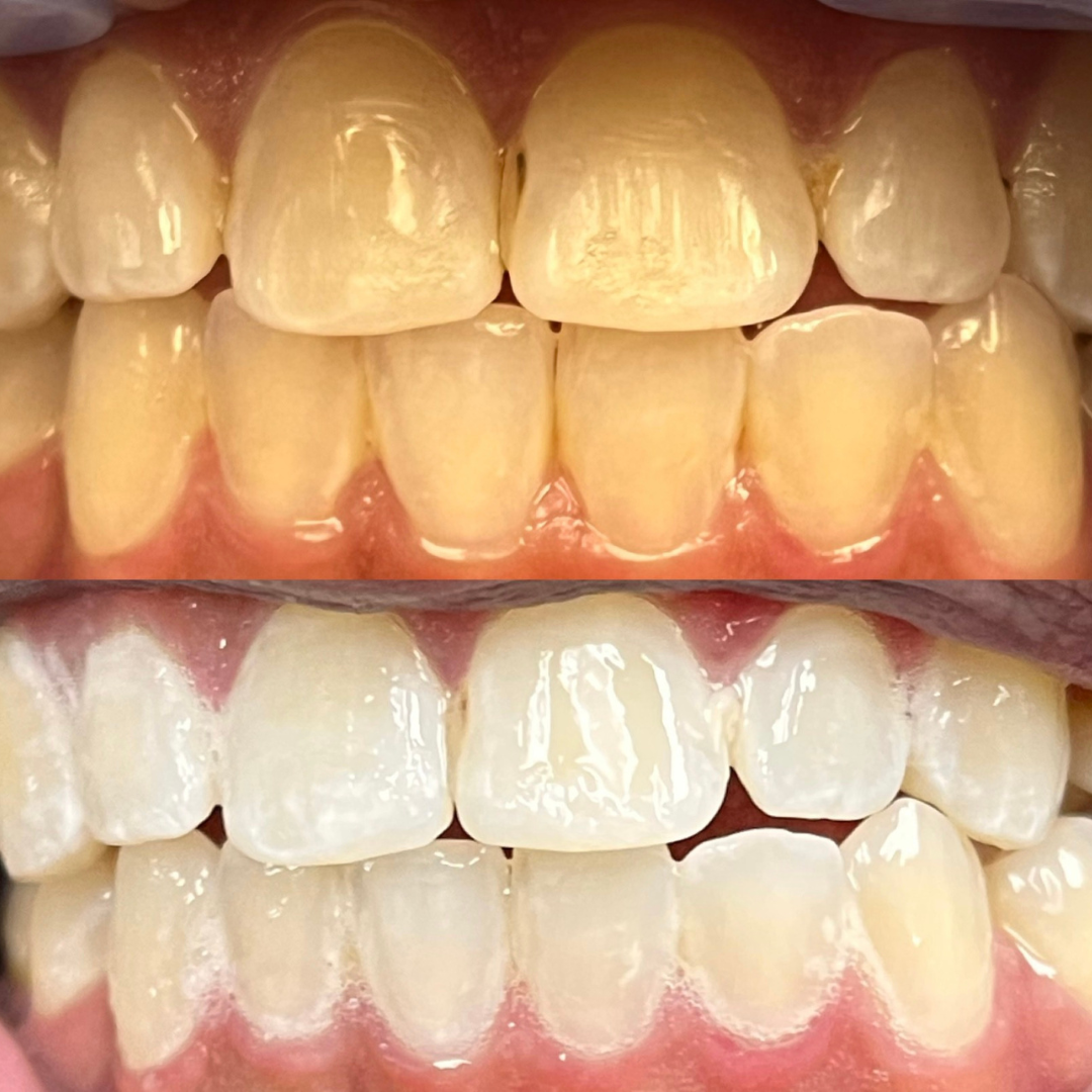Teeth whitening results, before and after